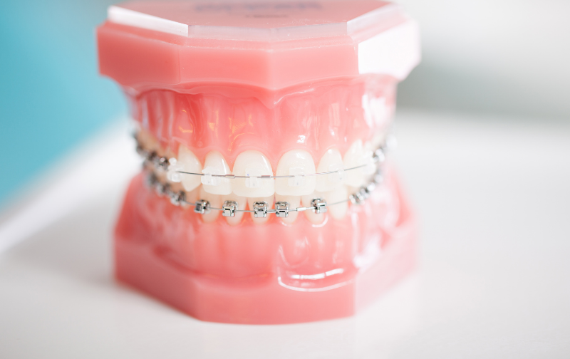 AutoBrush is a perfect fit for braces.