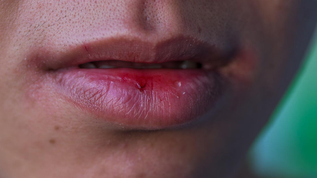 The True Culprit behind Cotton Mouth