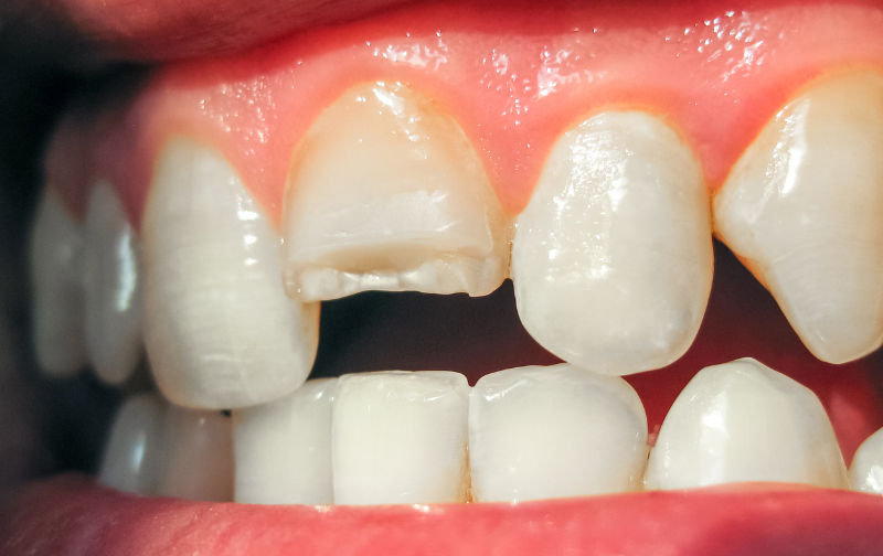 How to Treat Chipped & Cracked Teeth