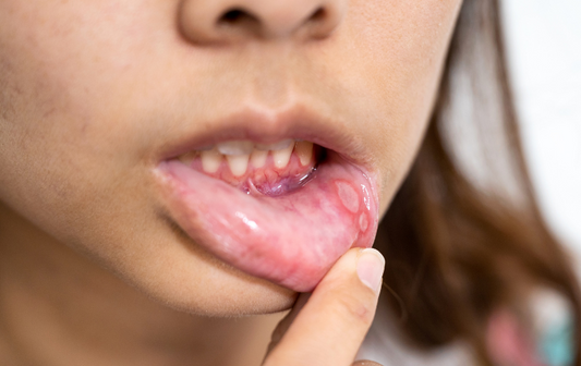 Canker Sores: How To Cure Them + Prevention 