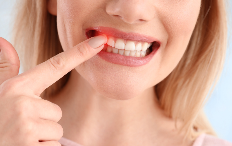 Bleeding Gums: What It Means and When to See a Dentist