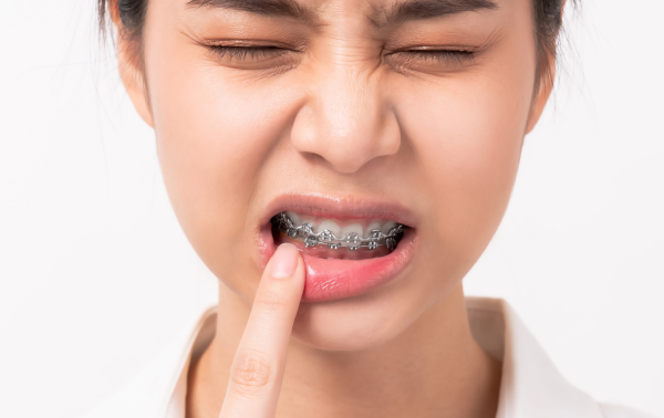 Keeping Your Breath Fresh While Wearing Braces