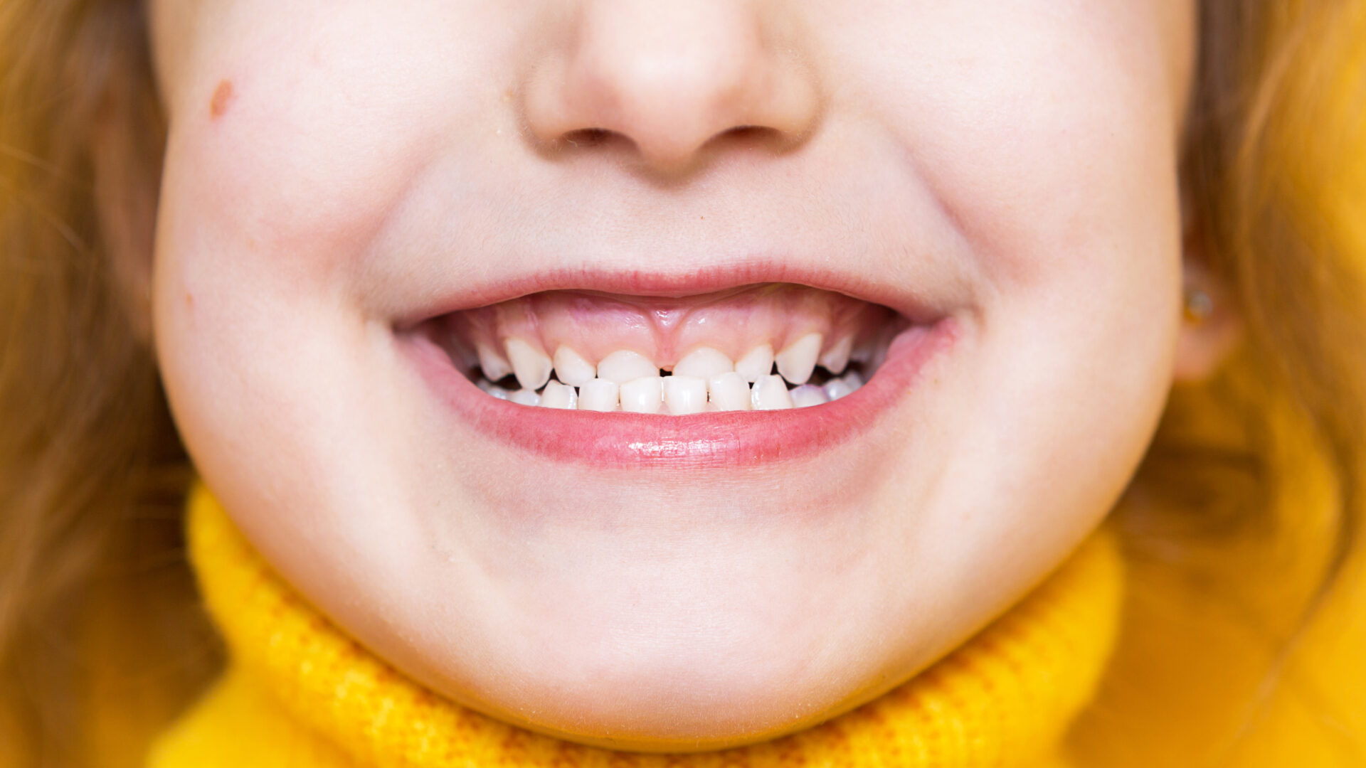 dau-hieu-nhan-biet-khop-can-nguoc-o-tre