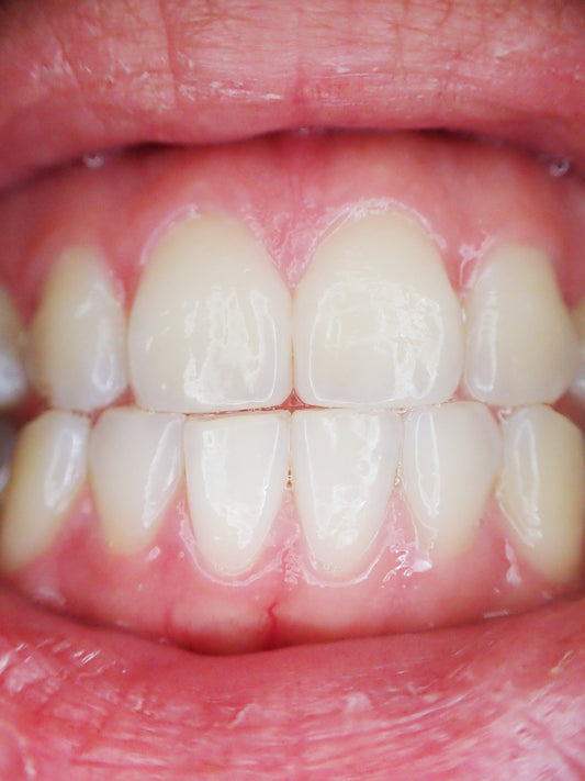Close up of someone's teeth and gums, for AutoBrush