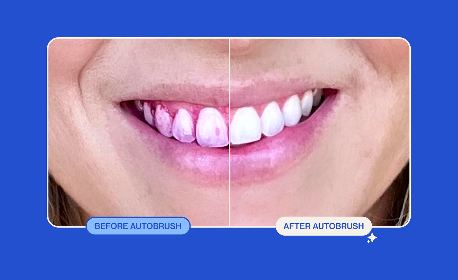 Before and after comparison of teeth cleaning with 'Autobrush' on a blue background.