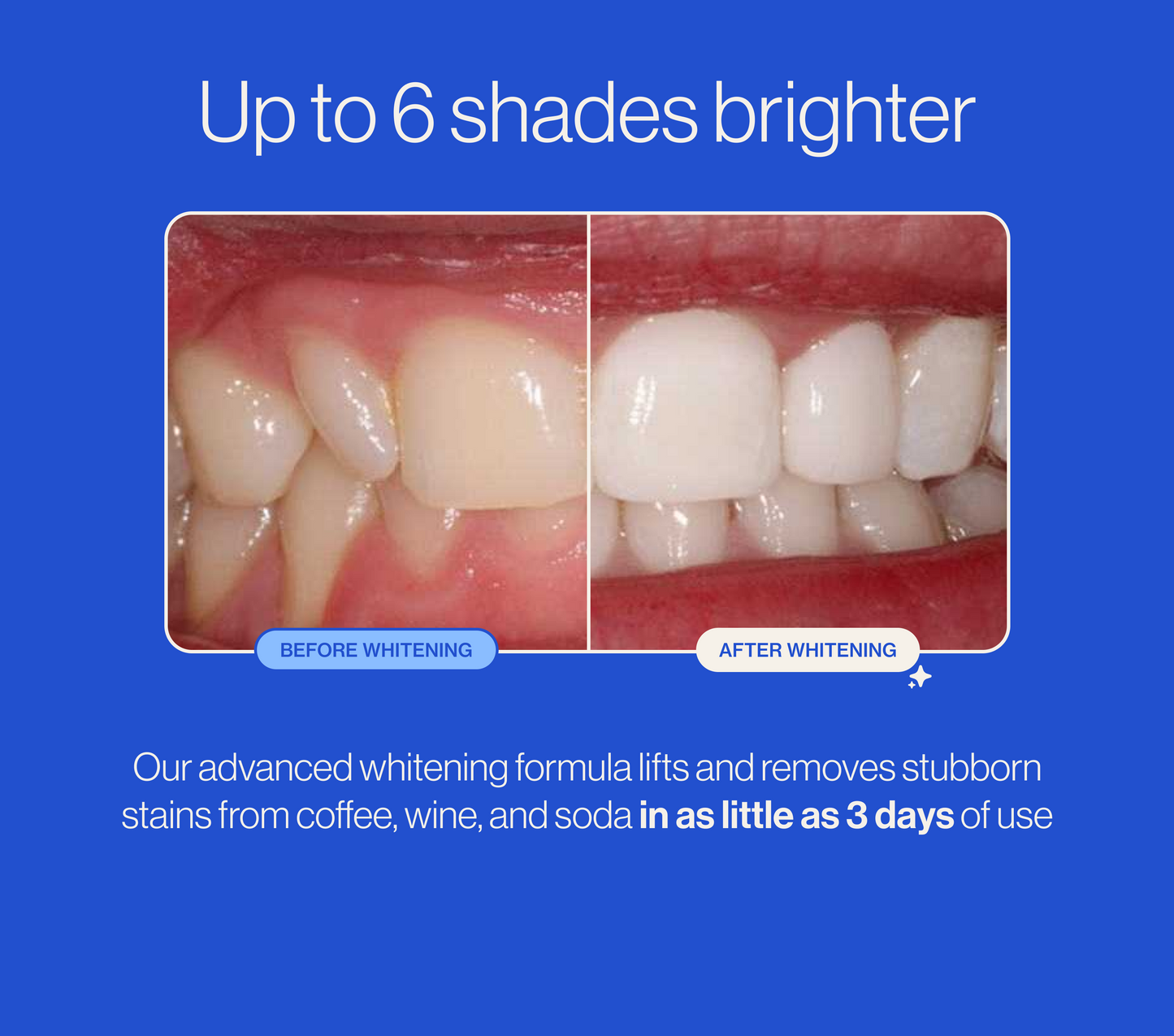 Before and after teeth whitening comparison with text on a blue background. #totalpackage  #whiteningg