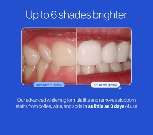 Before and after teeth whitening comparison with text on a blue background. #totalpackage  #whiteningg